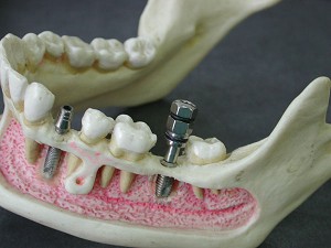 Имплантация зубов, фото