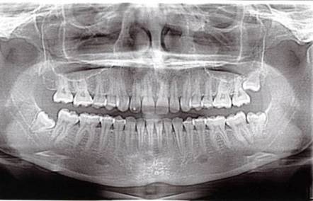 Панорамный снимок зубов, фото