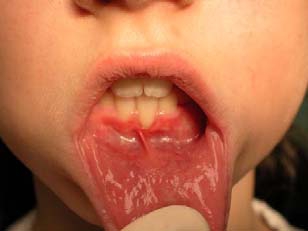 Пластика уздечки губ и языка, фото