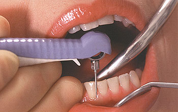Вектор терапия в стоматологии отзывы Имплантация зубов «под ключ» Томск Матросова