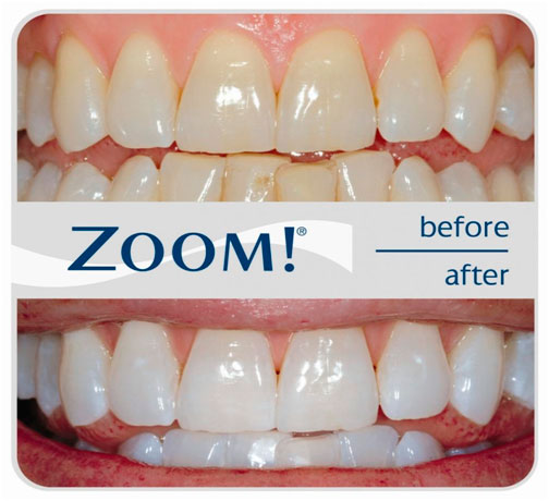 Отбеливание зубов Zoom системой, фото