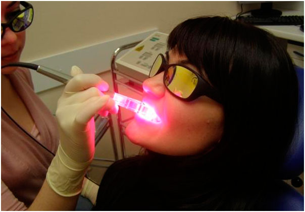 Лазерное отбеливание зубов, фото
