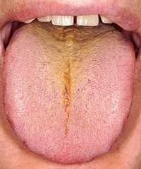 Налет на языке: особенная стоматологическая проблема!