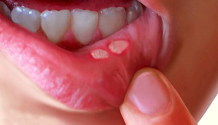 Когда следует обратиться к врачу при язвочках во рту