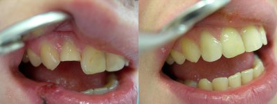 Наращивание зубов Томск Китайский стоматология герцена томск