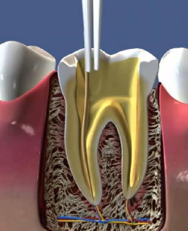 Современные методы удаления нерва из зуба - блог «ДИНАСТИЯ»