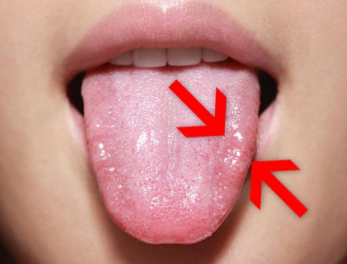 Как выглядит рак полости рта фото