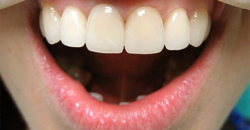 Шаги процесса установки коронок на передние зубы