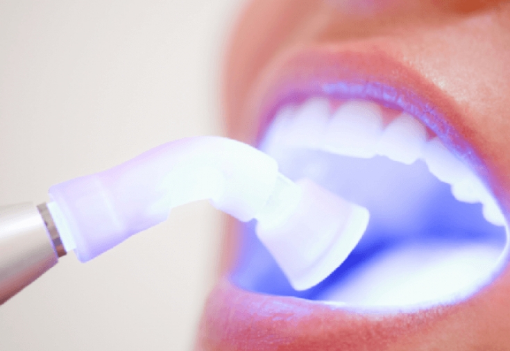 Лазерне відбілювання зубів, фото