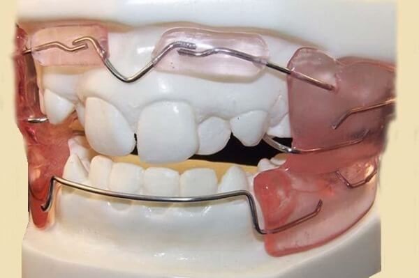 Ортодонтические аппараты, фото